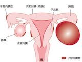 子宮内膜症のツボ